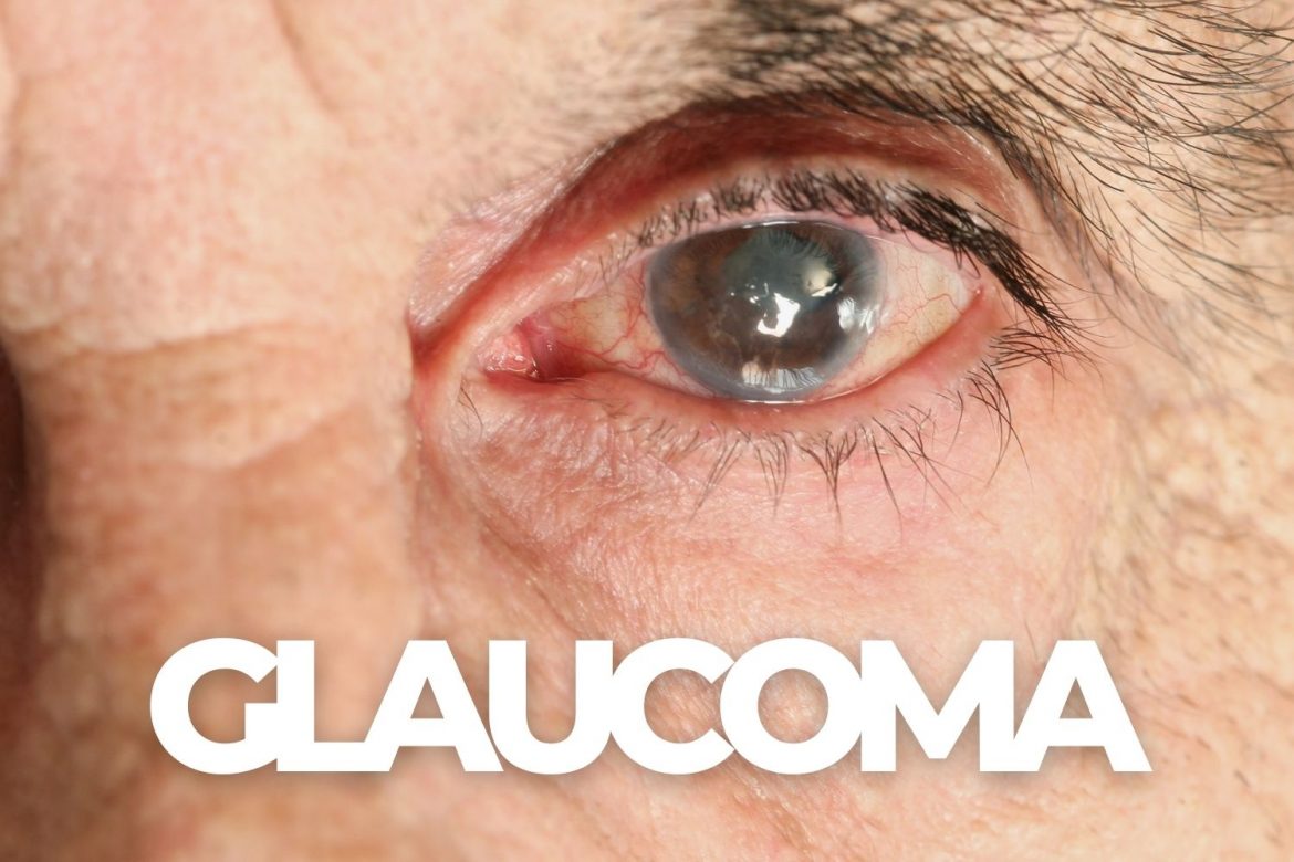 early signs of glaucoma