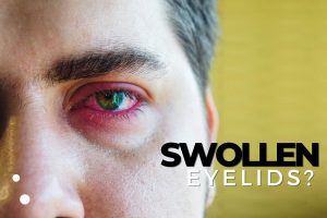 swollen eyelids